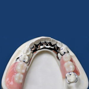 Cast Partial Denture / Full (Upper Or Lower)