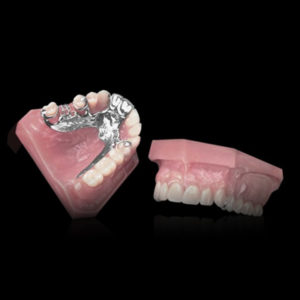 Partial Denture