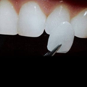 Veneers